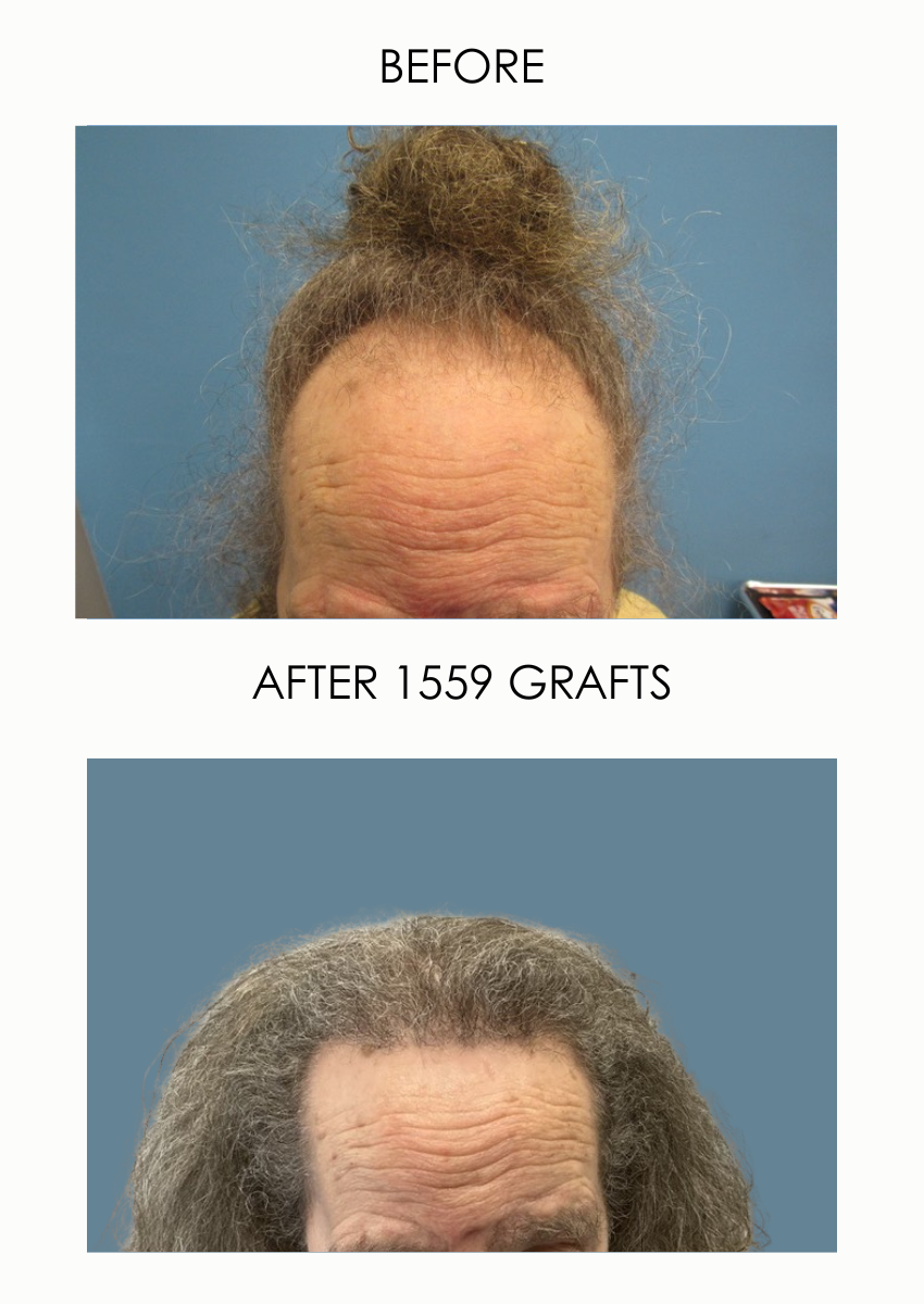 Male with gray hair before and after FUT