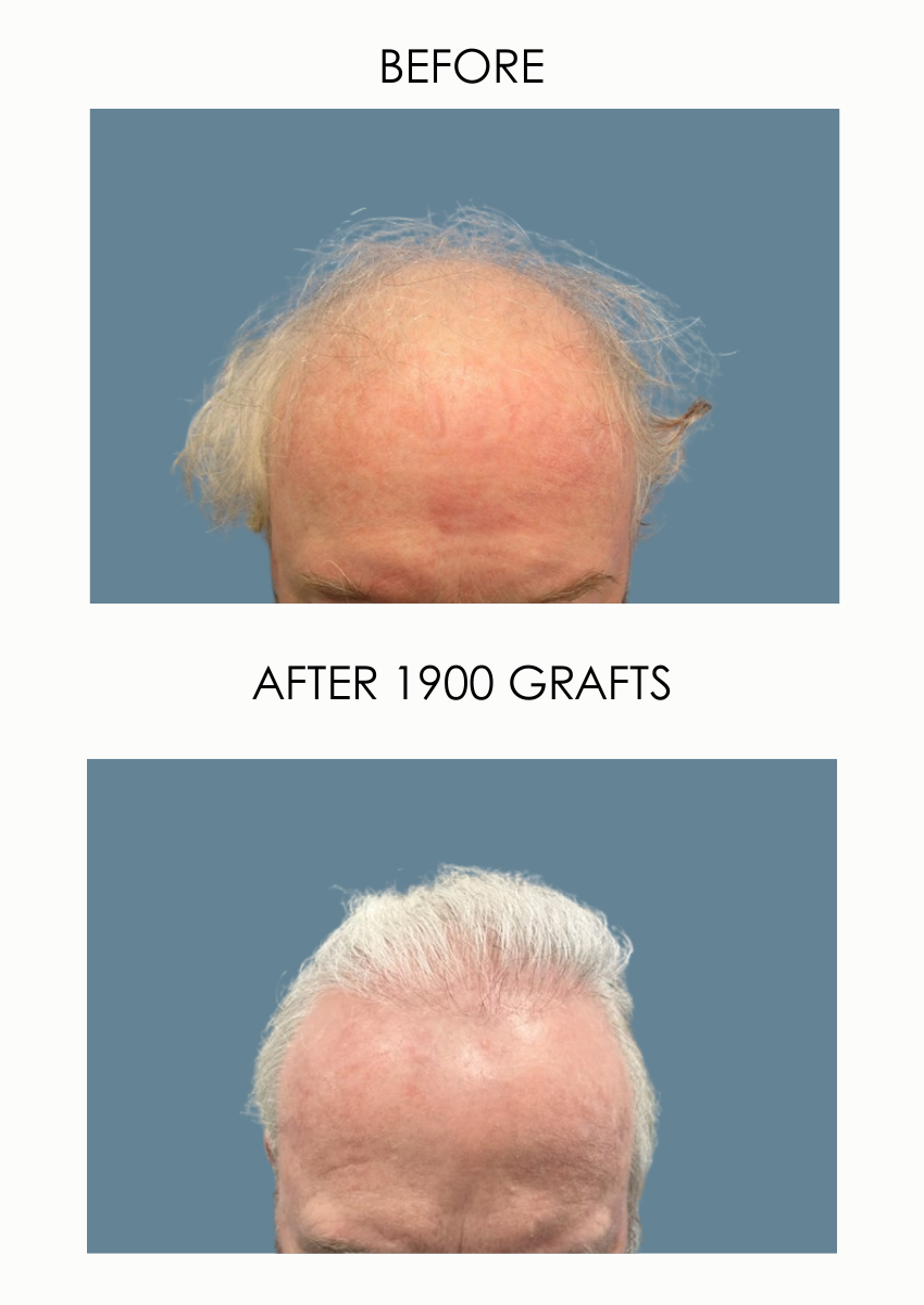 White male with white hair before and after hair transplant 1900 grafts