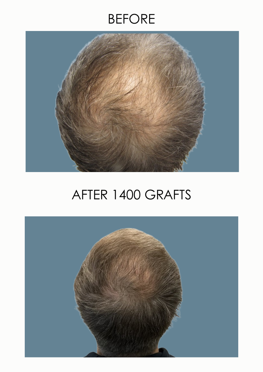 BEFORE & AFTER FUT 1400 grafts