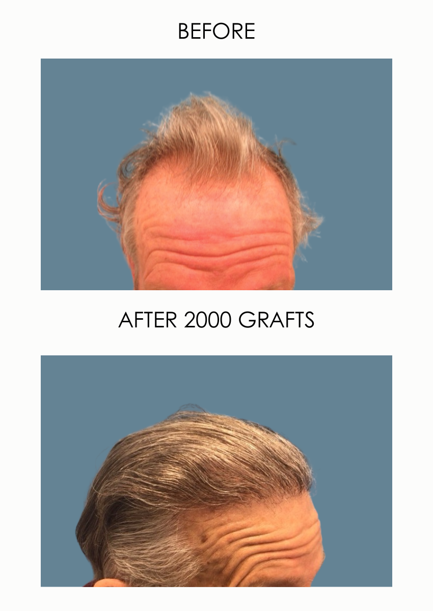 Male with gray hair before and after hair transplant